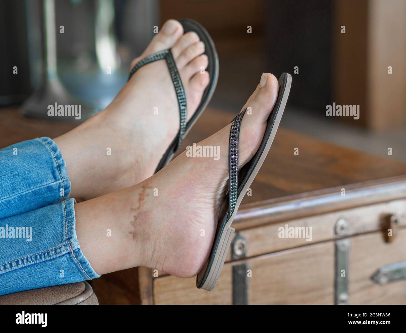 Legs of caucasian woman in flip flops who suffers from broken ankle. Scar on left foot after surgery.  Stock Photo