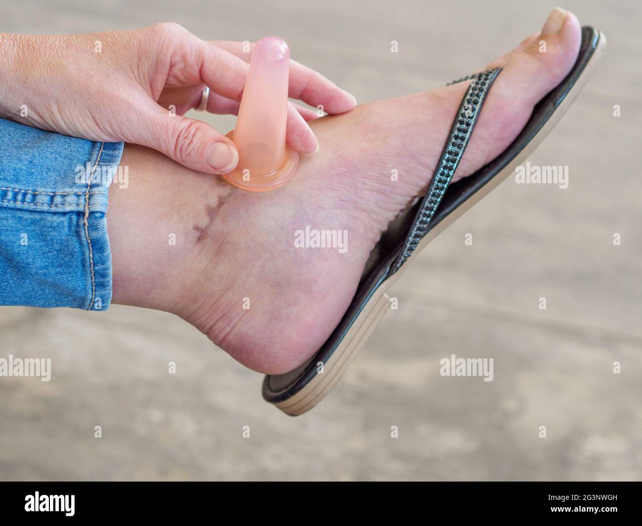 Scar tissue massage of caucasian woman suffering from broken ankle. Improving range of motion by cupping.  Stock Photo