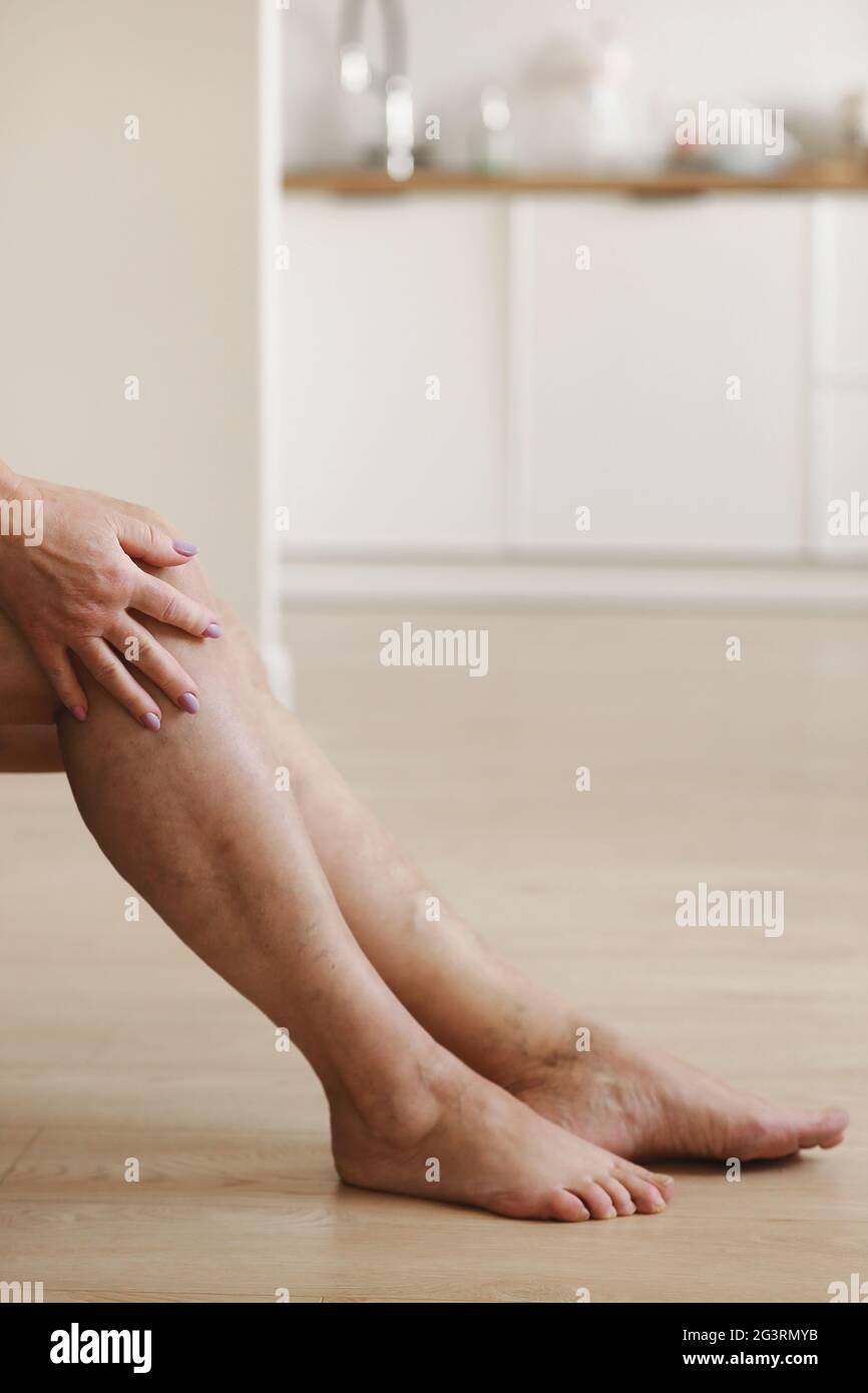 Painful varicose and spider veins on active womans legs, selfhelping