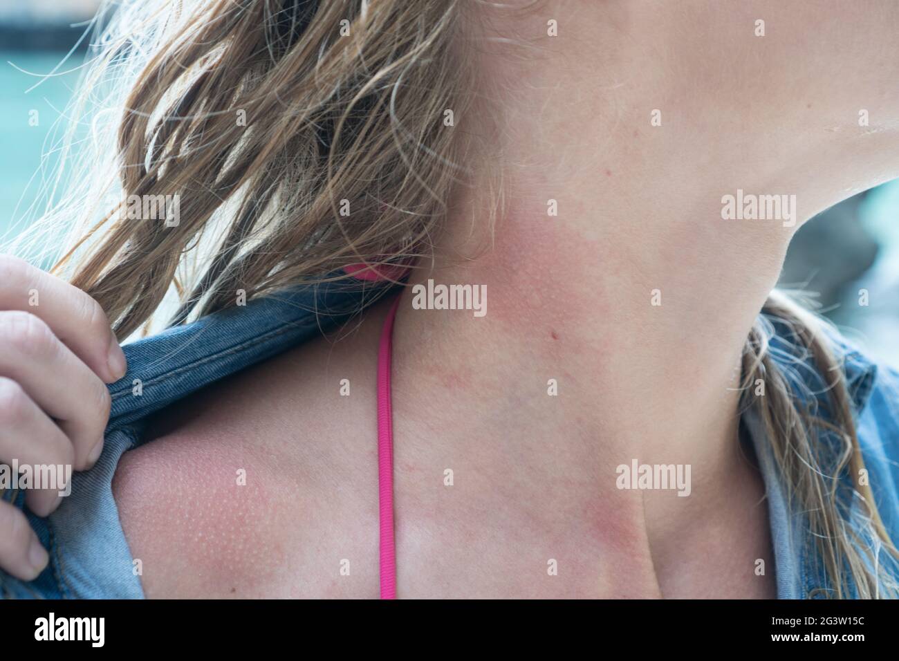 Woman's neck with jelly fish bite Stock Photo