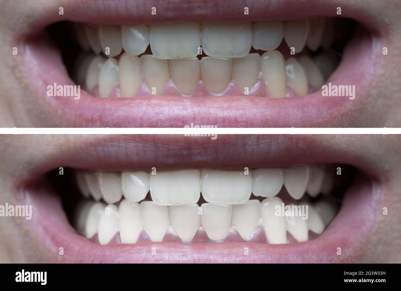 Teeth whitening before after Stock Photo - Alamy
