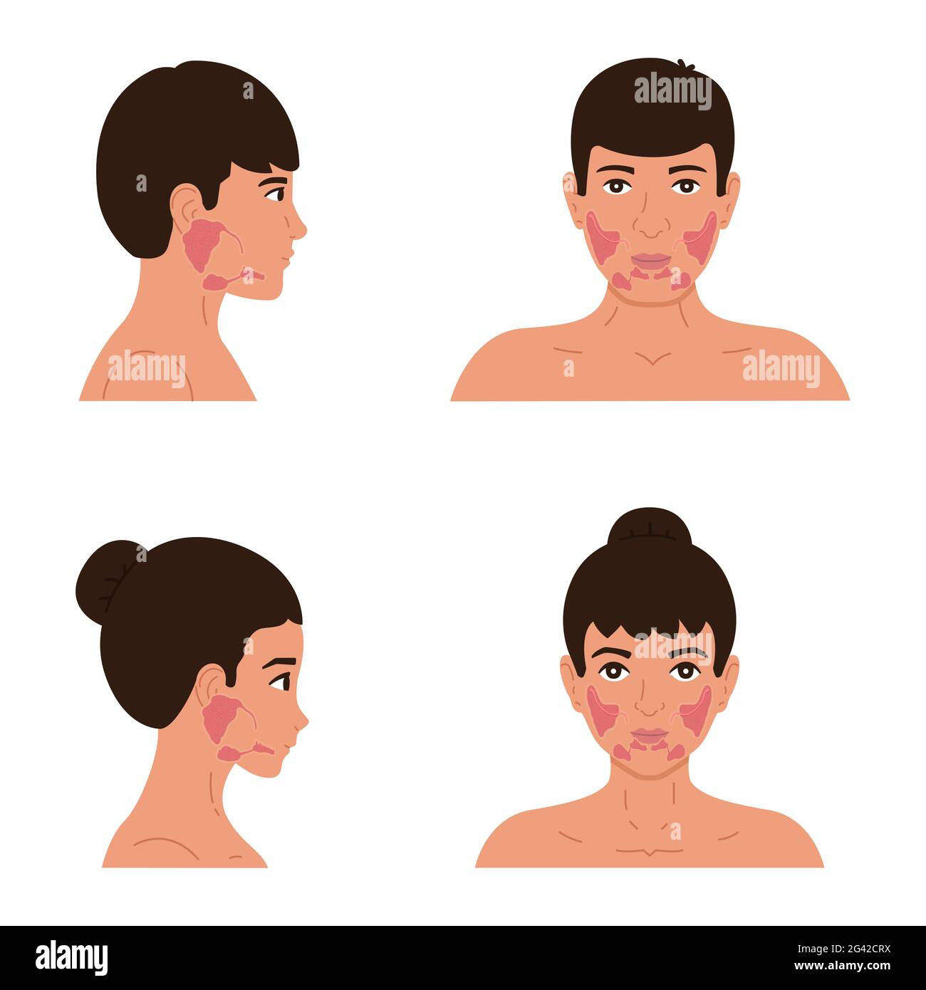 The location of the parotid, submandibular and sublingual salivary glands in the male and female body. Flat vector illustration Stock Photo