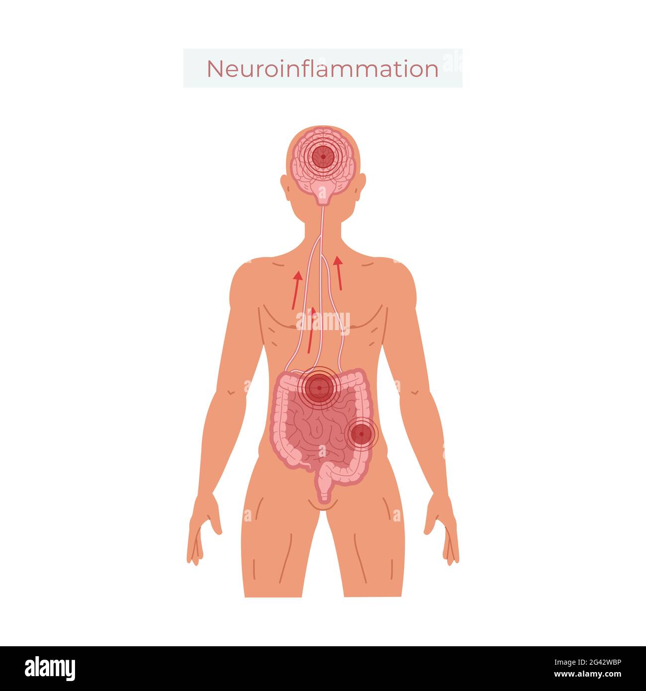 Poor gut health leads to neuroinflammation vector illustration. Stock Photo