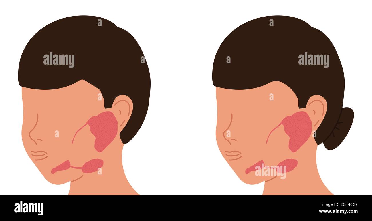 Localization of salivary glands in males and females. Medical vector illustration. Stock Photo