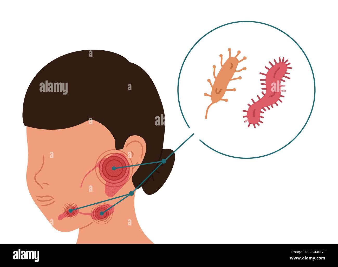 A woman with bacterial inflammation of the salivary glands. Vector illustration of sialolithiasis. Stock Photo
