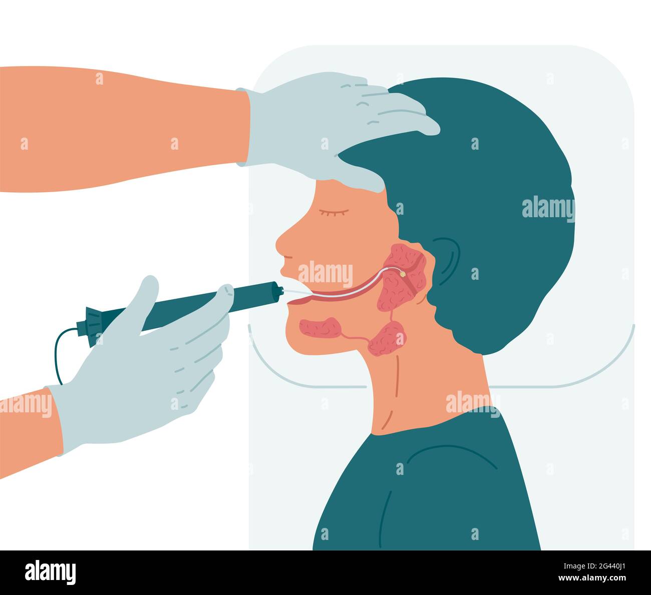 Surgery to remove a stone from the duct of the parotid salivary gland. Stock Photo