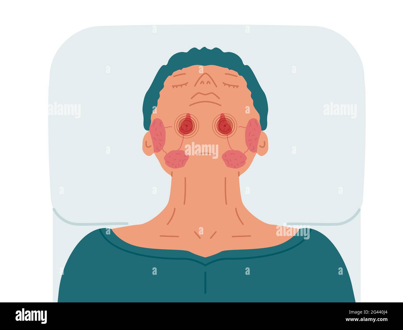 A patient with diseased sublingual salivary glands. Vector illustration of sialolithiasis. Stock Photo