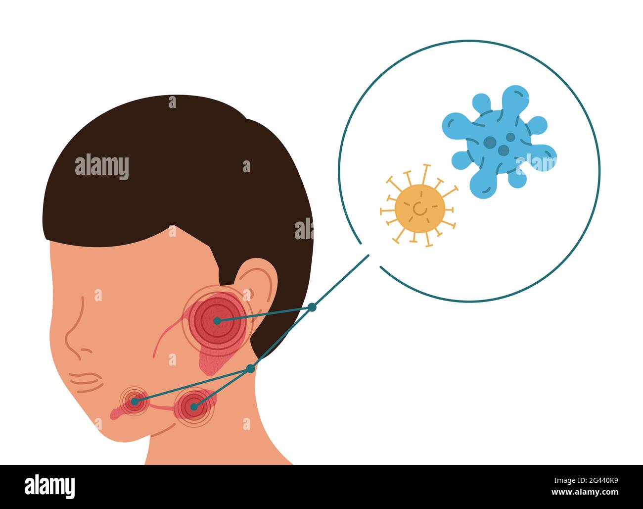A person with viral inflammation of the salivary glands. Vector illustration of sialolithiasis. Stock Photo