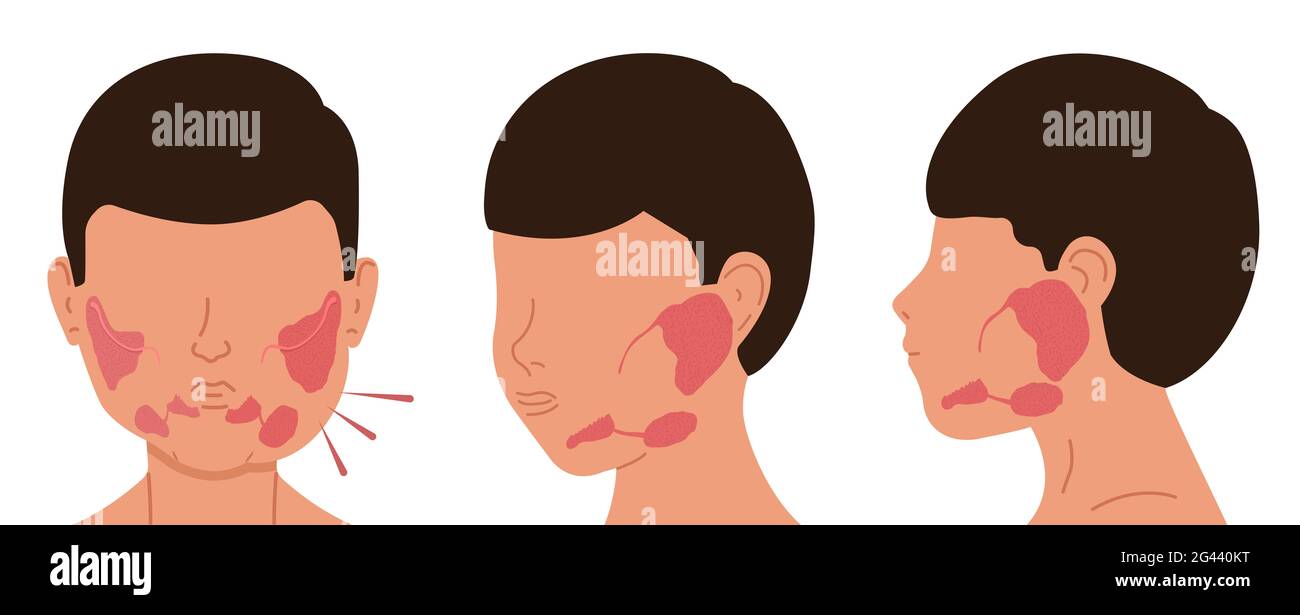 Person with sick and healthy salivary glands. Vector illustration of sialolithiasis. Stock Photo
