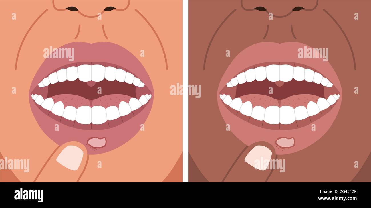 Vector illustration canker sore, aphthous ulcer on the lip, stomatitis. Stock Photo