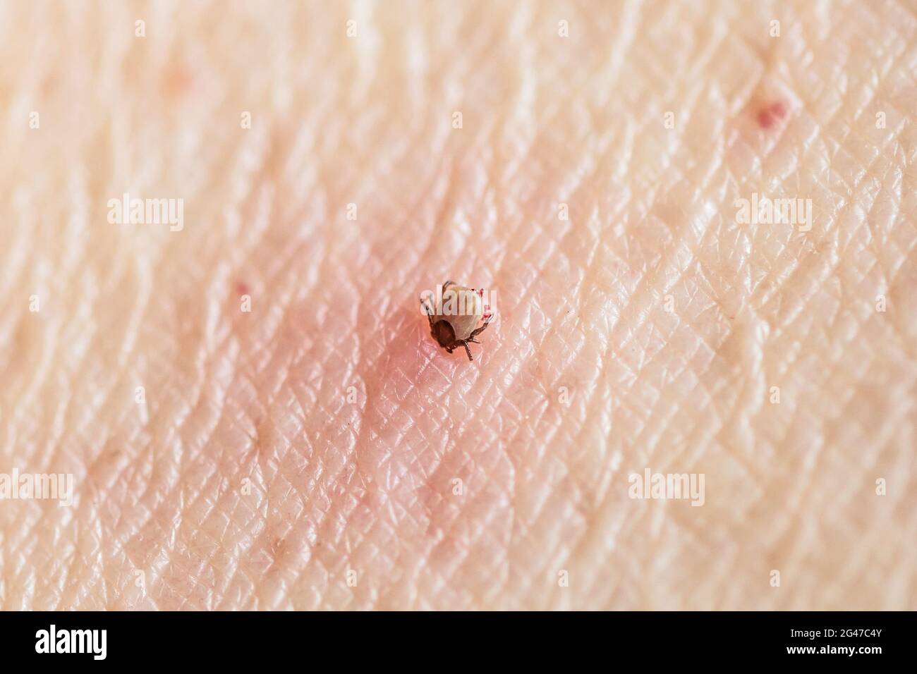 Engorged, feeding adult female deer tick, Ixodes scapularis, laying red eggs, protruding under it's body, sucking blood from skin of human female. Stock Photo