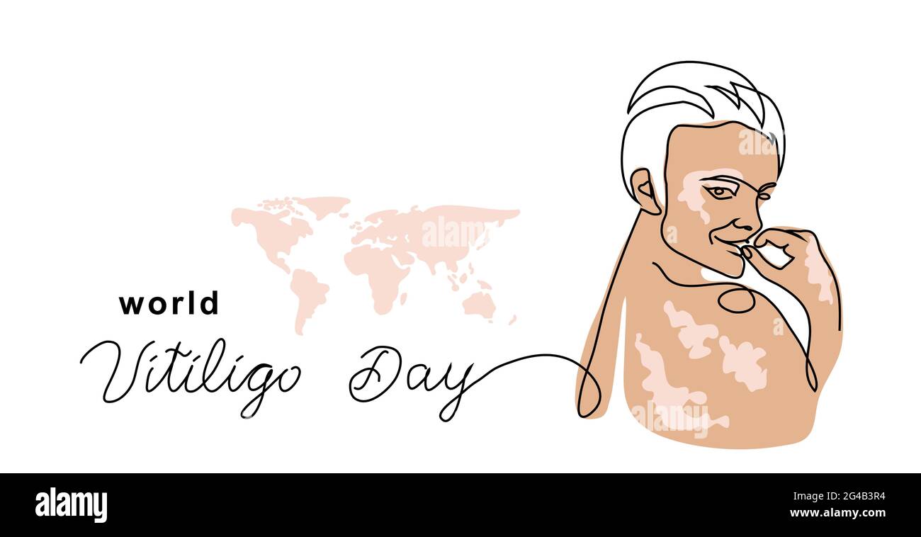 Vitiligo skin simple vector banner, poster, background. Person with skin pigmentation. One continuous line art drawing and lettering world vitiligo Stock Vector