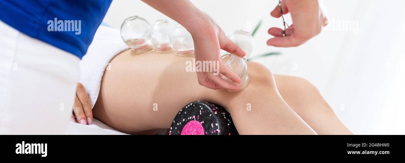 https://c8.alamy.com/comp/2G4BHW0/vacuum-cupping-therapy-banner-young-female-physiotherapist-applying-suction-cups-on-the-leg-of-her-patient-to-relieve-muscle-pain-closeup-detail-2G4BHW0.jpg