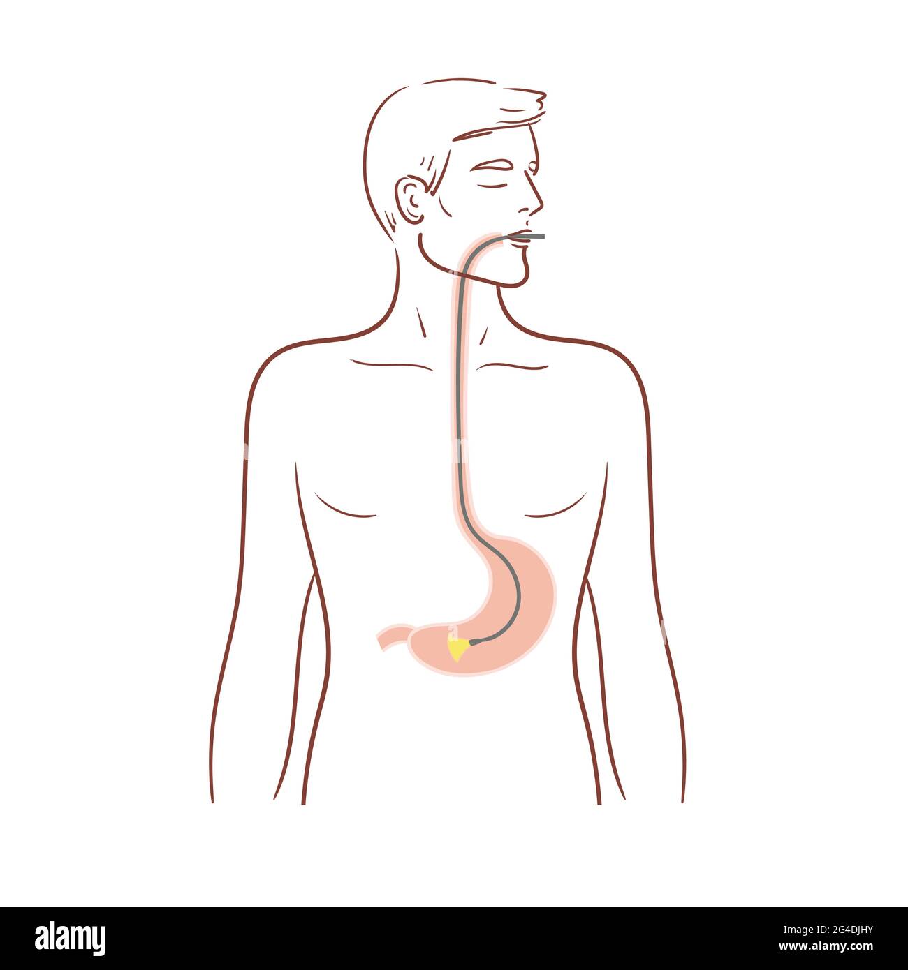 Gastroscopy of the stomach. Esophagoscopy,diagnostic procedure.A man is undergoing a medical examination. Stock isolated illustration on white Stock Vector