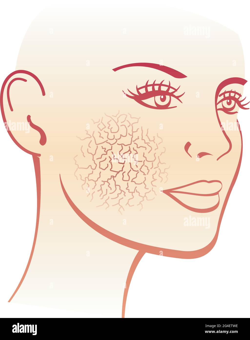 Medical illustration of the symptoms of dry skin. Stock Vector