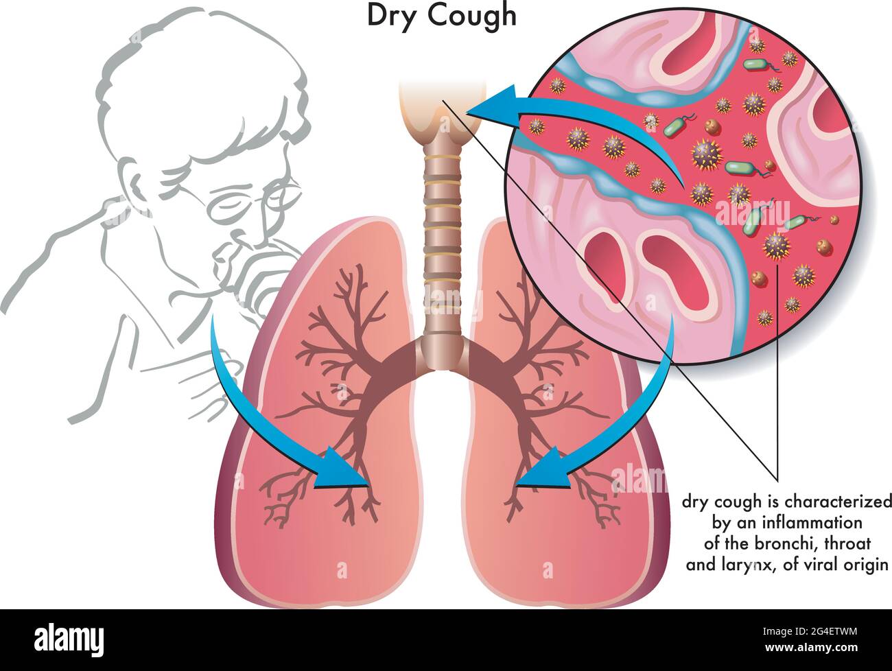 Medical illustration of the symptoms of dry cough Stock Vector Image