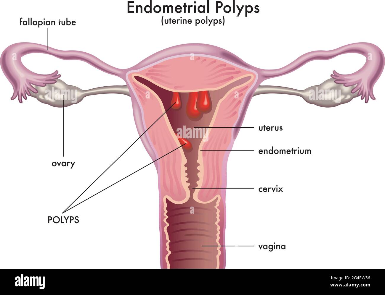 Medical illustration shows a female reproductive system with endometrial polyps. Stock Vector