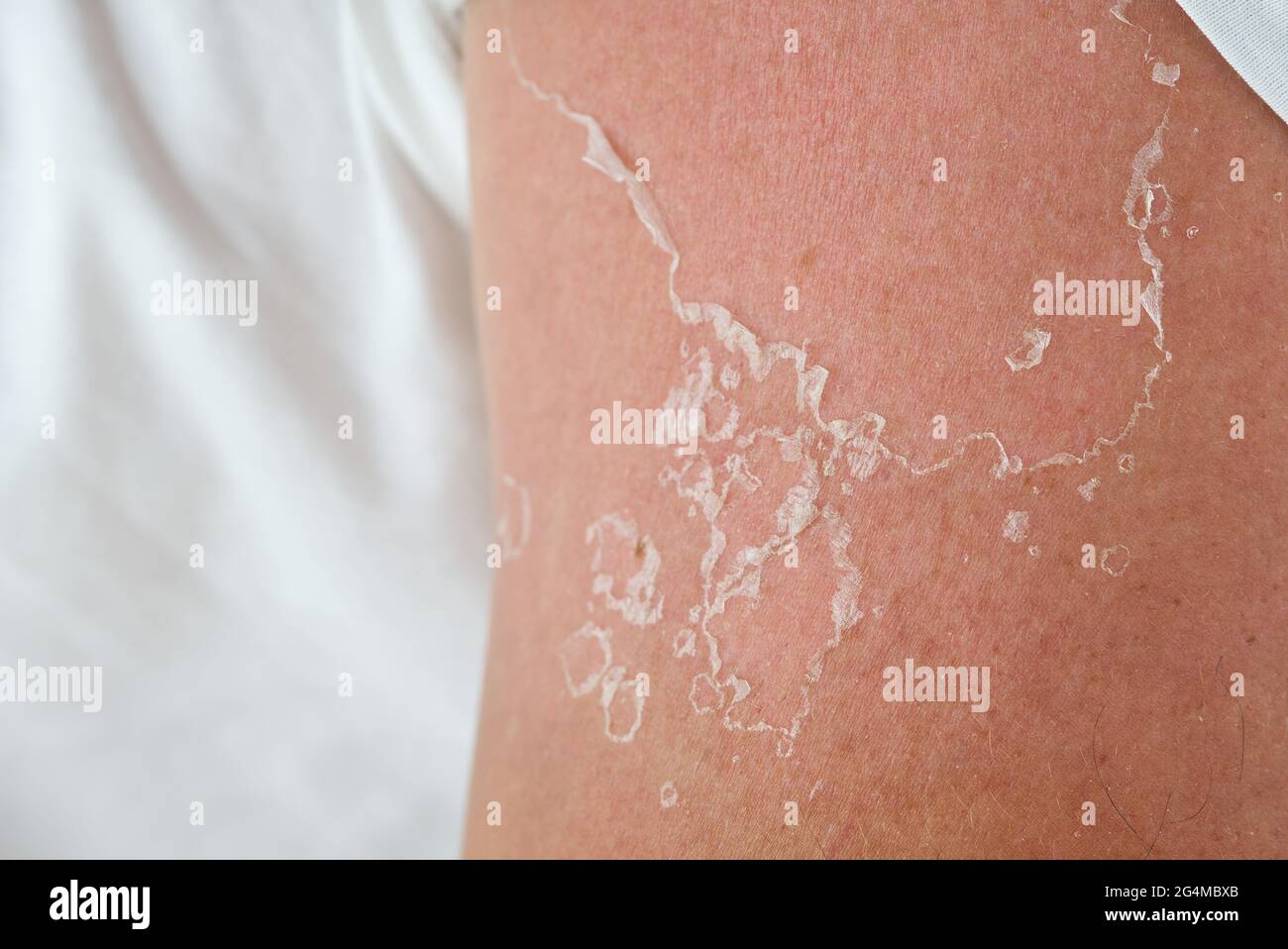 peeling of skin after burned by sunlight. not using sunscreen Stock