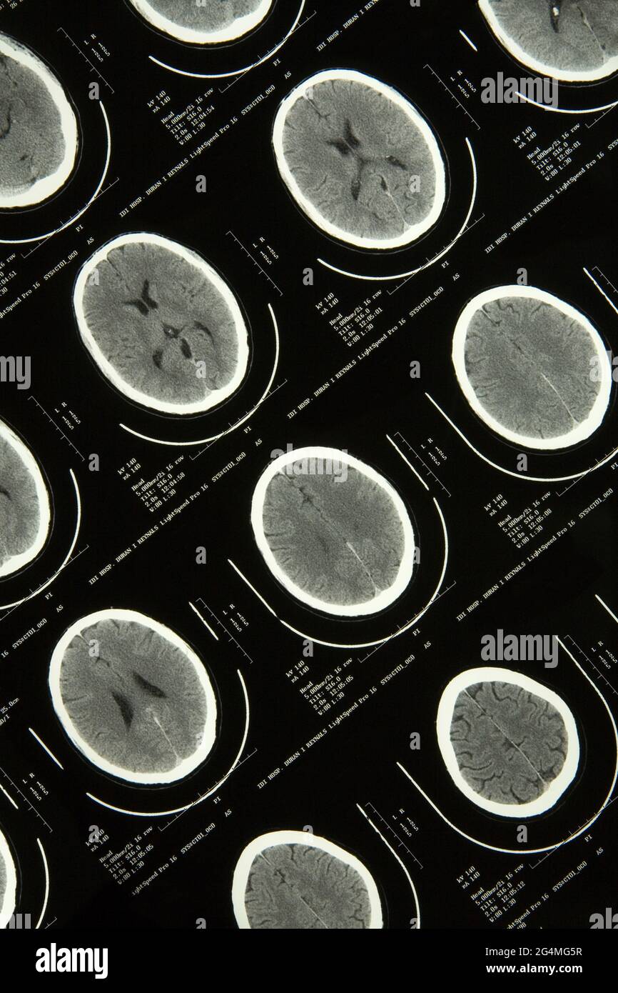 MRI Brain scan Stock Photo
