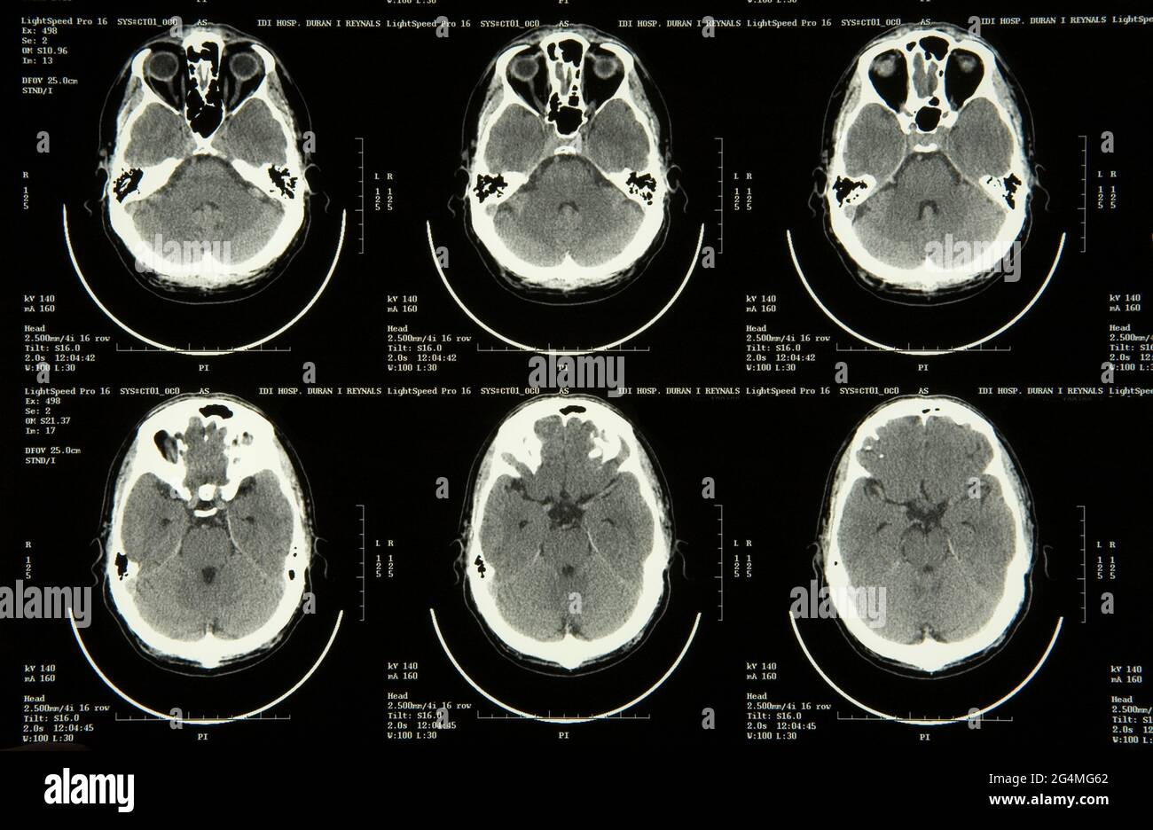MRI Brain scan Stock Photo