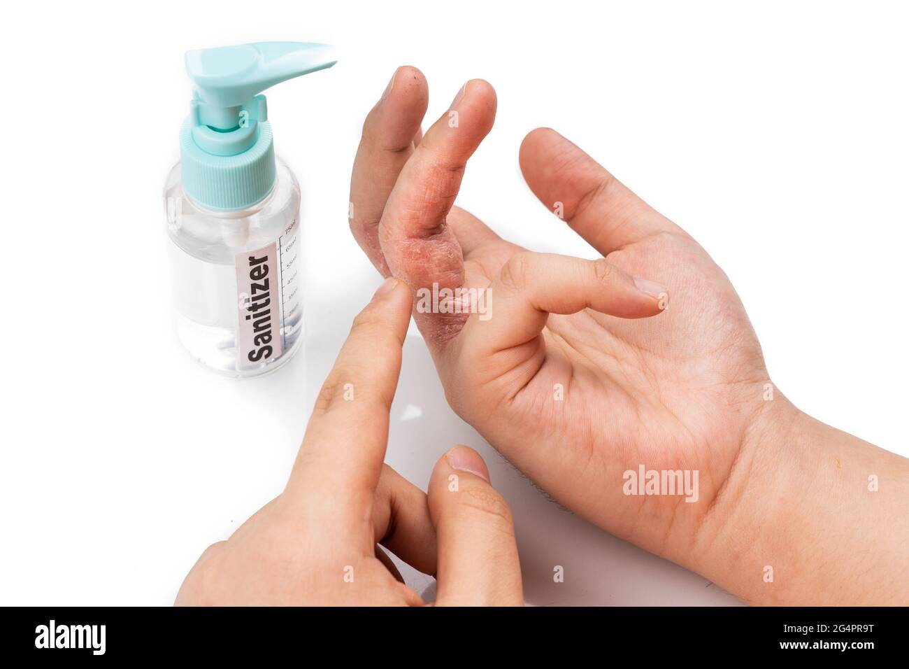 Dry skin finger with bottle of hand sanitizer. Sanitizer causes dryness
