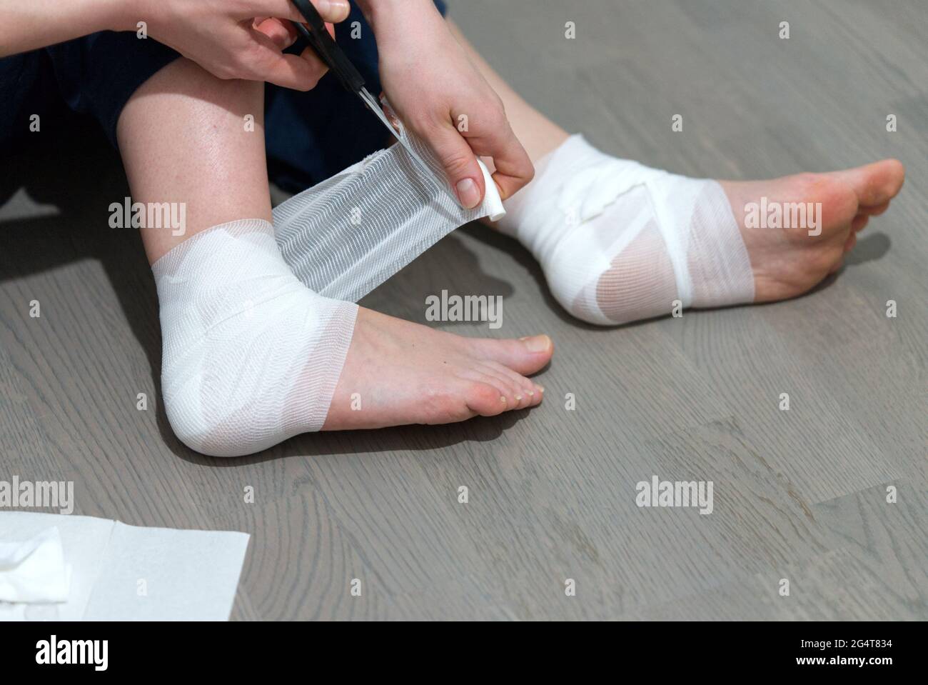 callus on leg. Girl uses ointment, Band-Aid and bandage to treat calluse Stock Photo