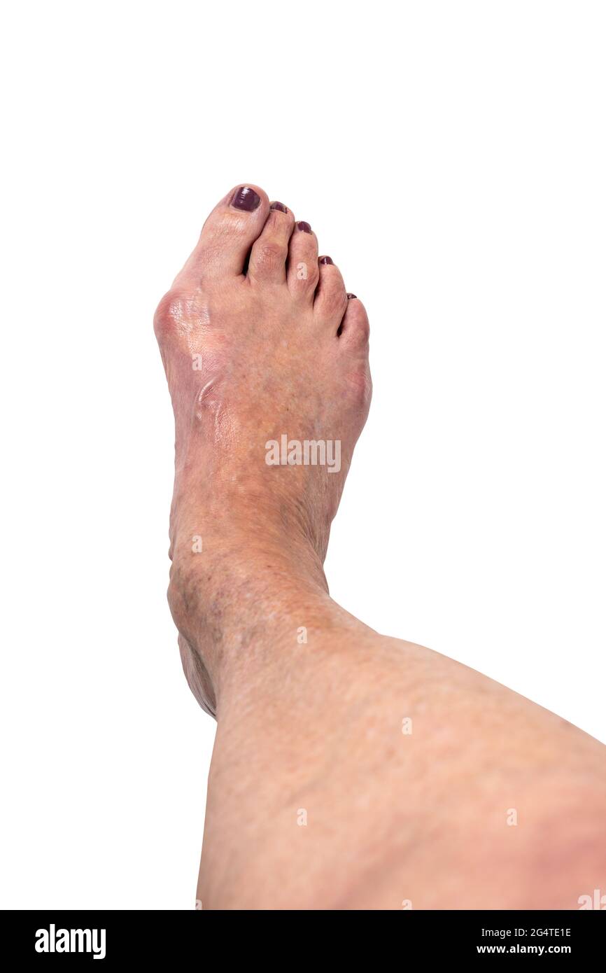 Hallux valgus, bunion on elderly woman's foot isolated on white background. Painful toe joint deformity with toe misalignment. Orthopedic diagnosis. Stock Photo