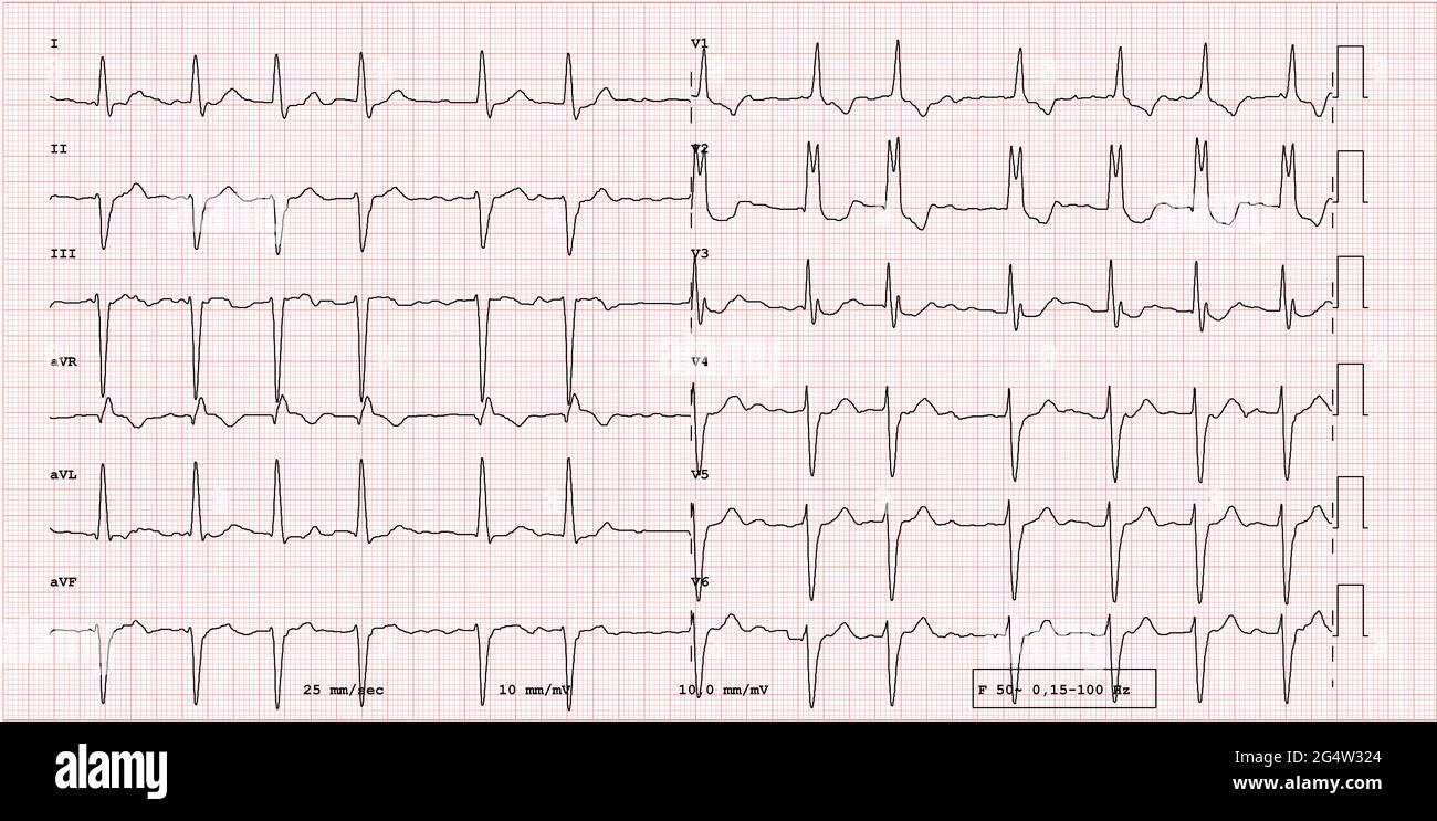 Pathological 12-lead ECG, right branch block, left branch hemiblock and atrial fibrillation Stock Photo