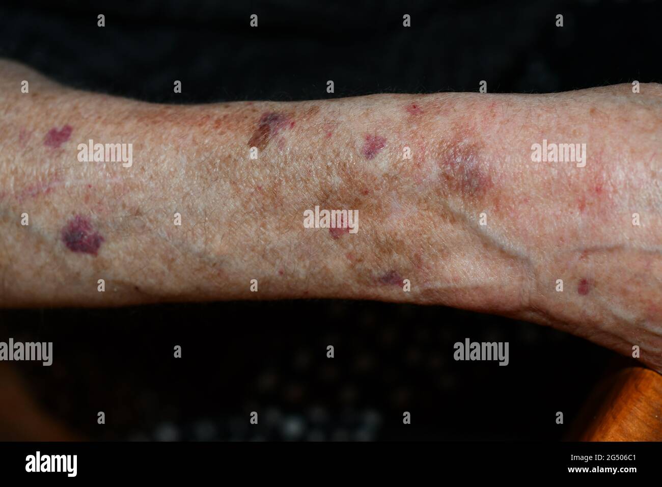 Bruised and sun damaged arm Stock Photo Alamy