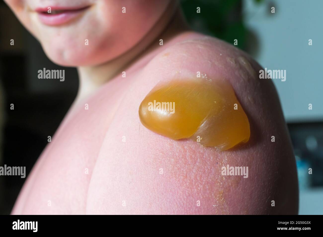 Thick nasty blister from a sunburn Stock Photo