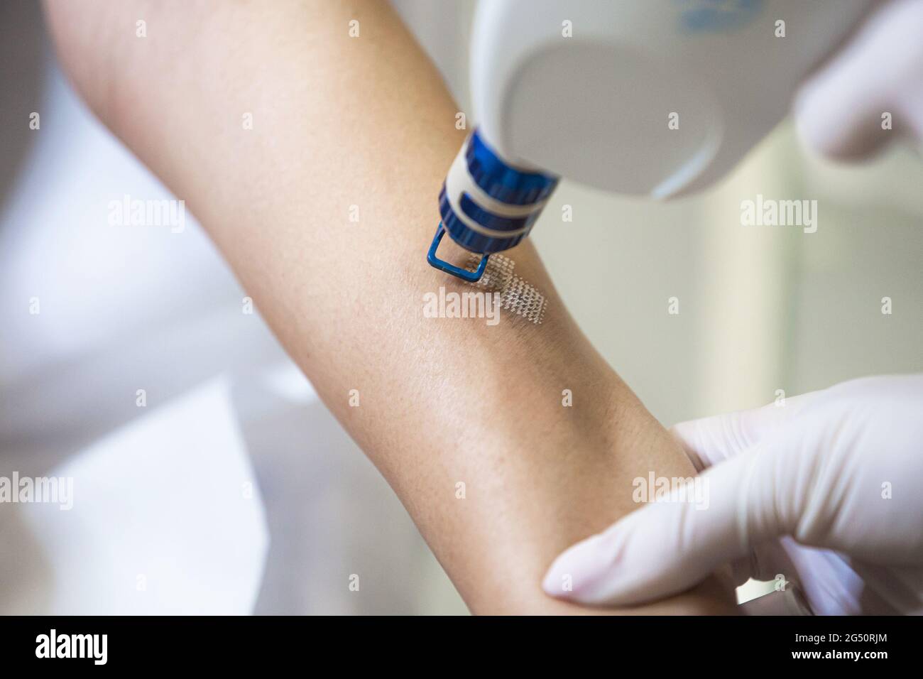 Laser hair or atopic eczema scar removal from the skin. CO2 technique Stock Photo - Alamy Laser hair or atopic eczema scar removal from the skin. CO2 technique Stock Photo - Alamy