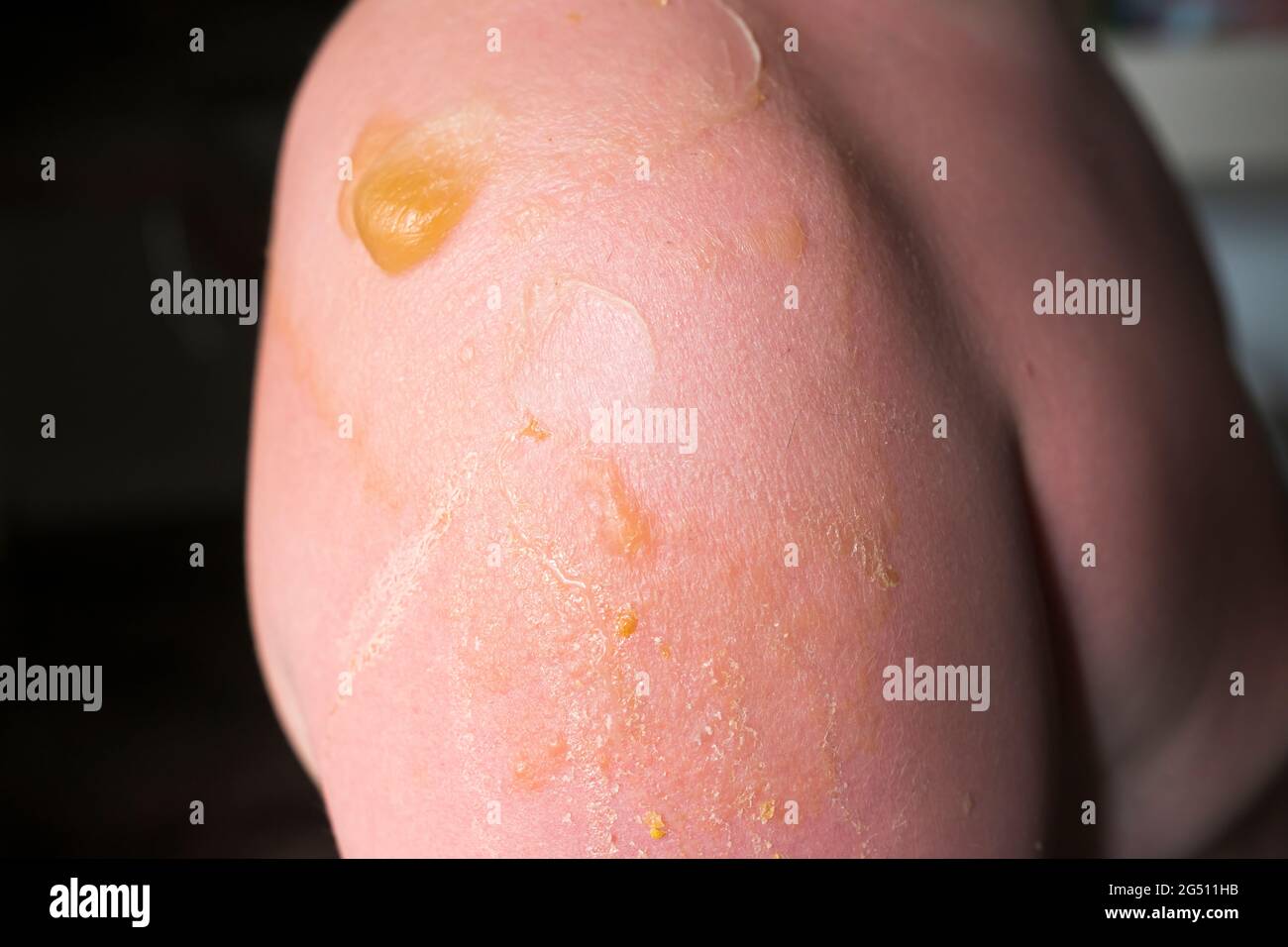 Skin damaged from the sunburn Stock Photo