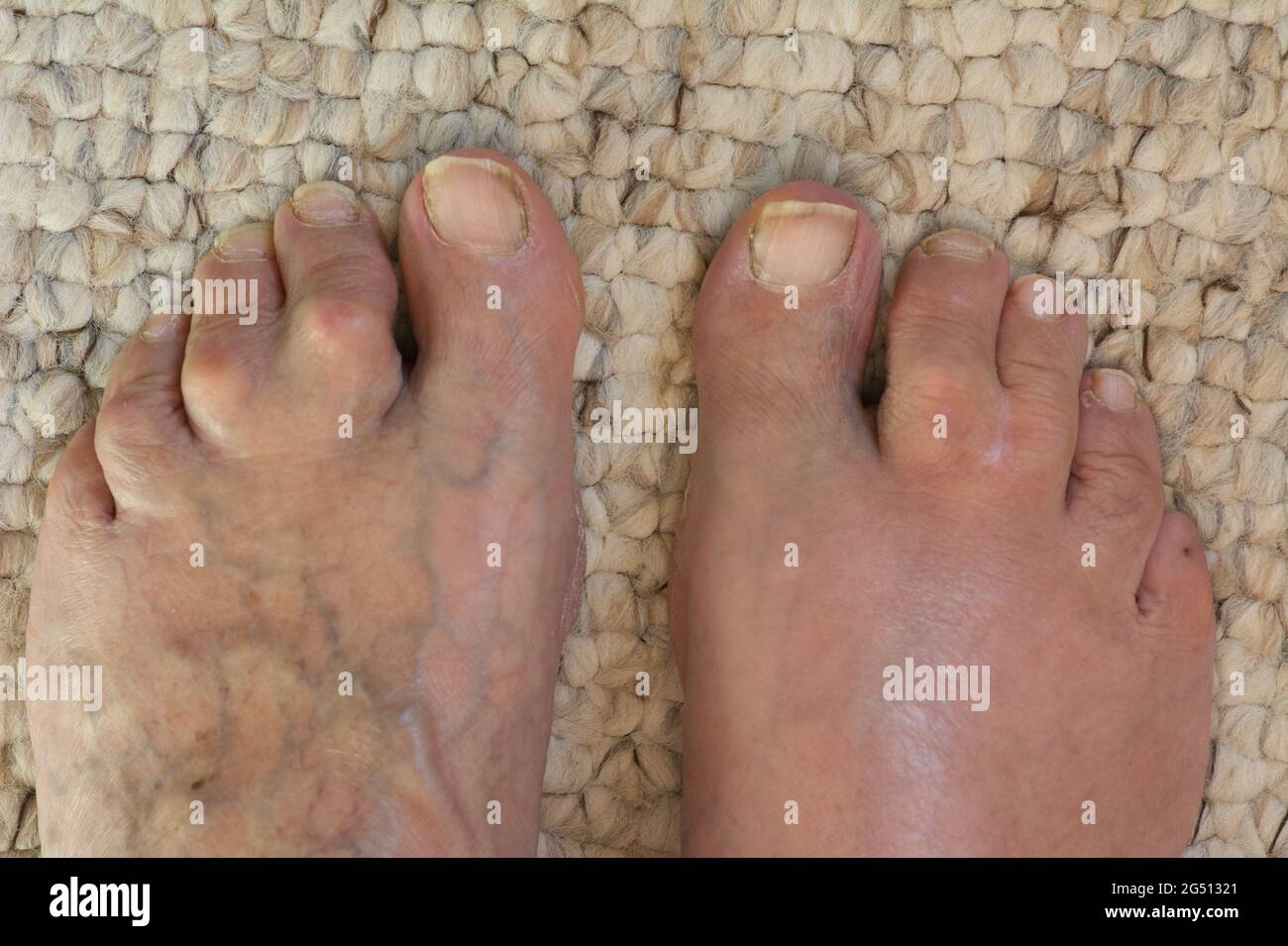 Woman's feet displaying webbed toes, varicose veins and in one foot, cellulitis Stock Photo