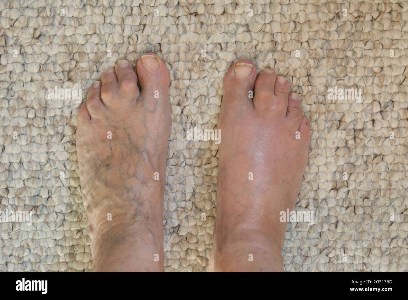 Woman's feet displaying webbed toes, varicose veins and in one foot, cellulitis Stock Photo