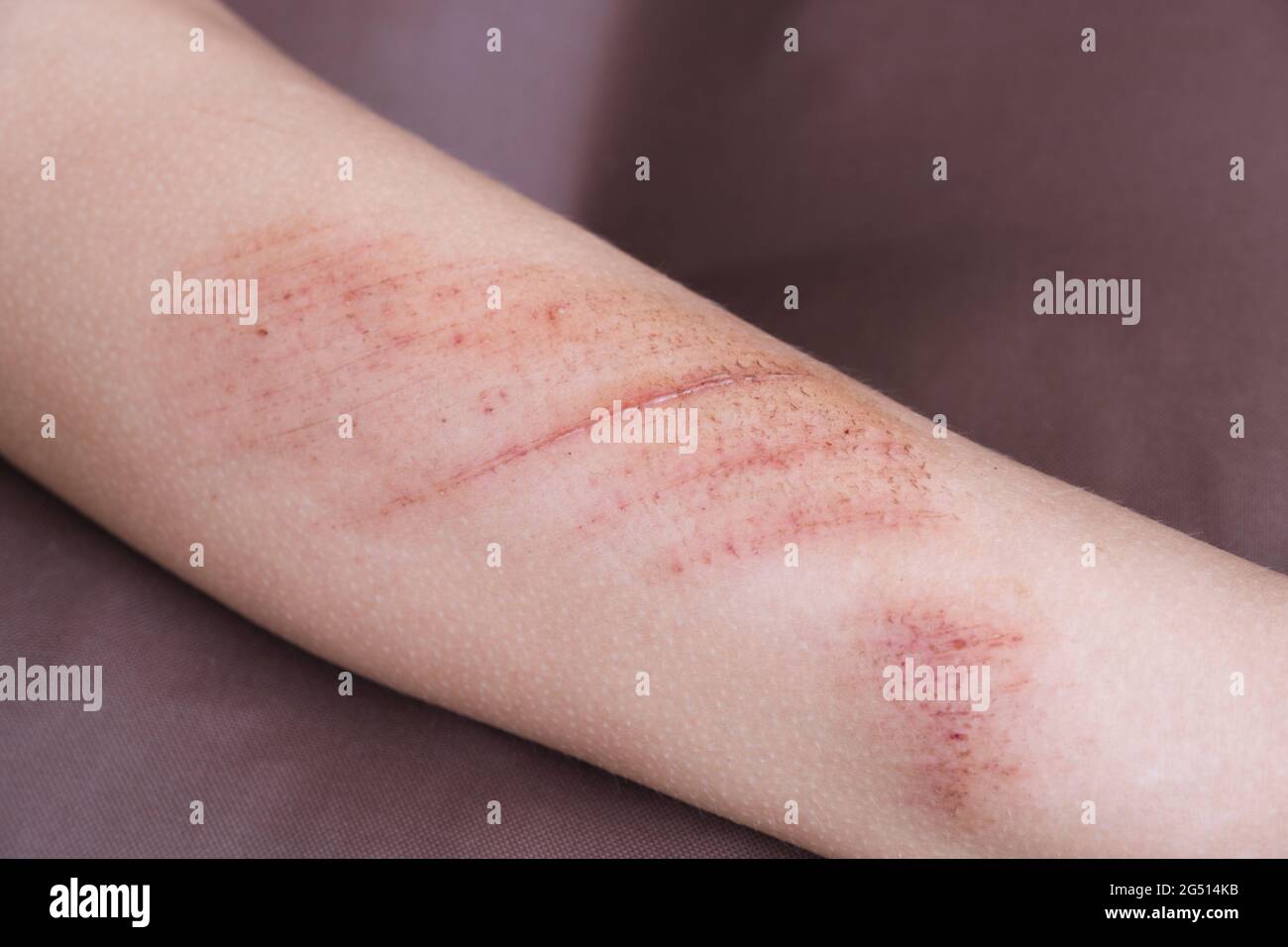 Share more than 119 do nail scratches leave scars latest