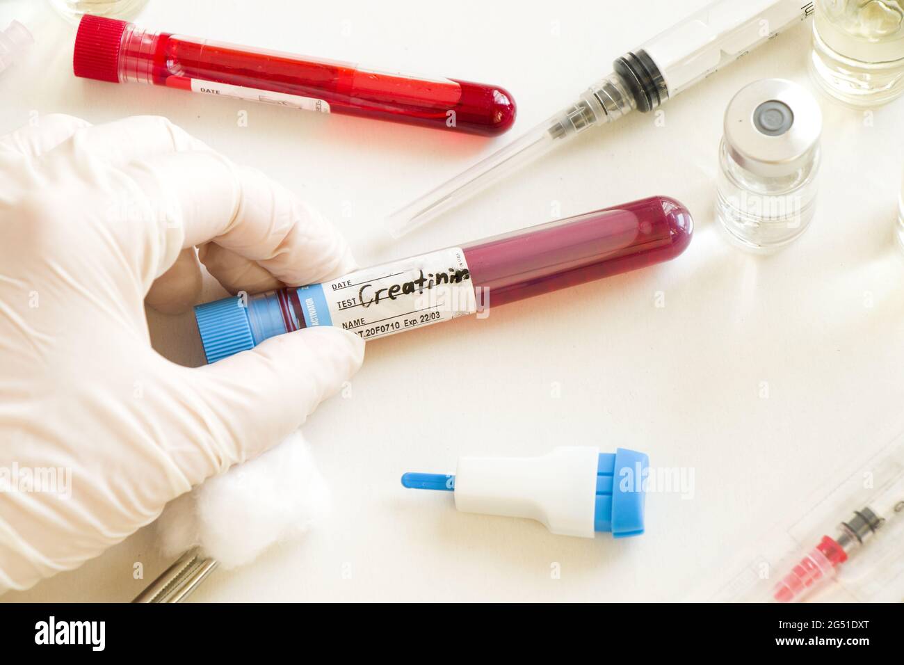 Closeup shot of a gloved hand holding a creatinine blood test sample in