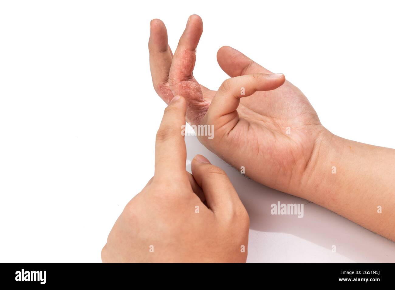 Extreme dry skin on fingers of person on white background Stock Photo