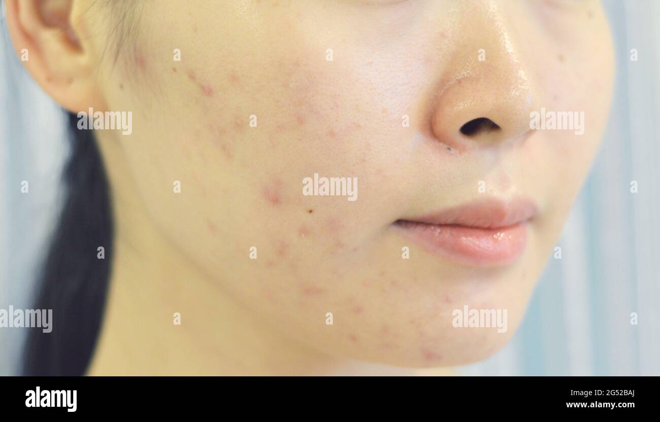 Skin blemishes hi-res stock photography and images - Alamy