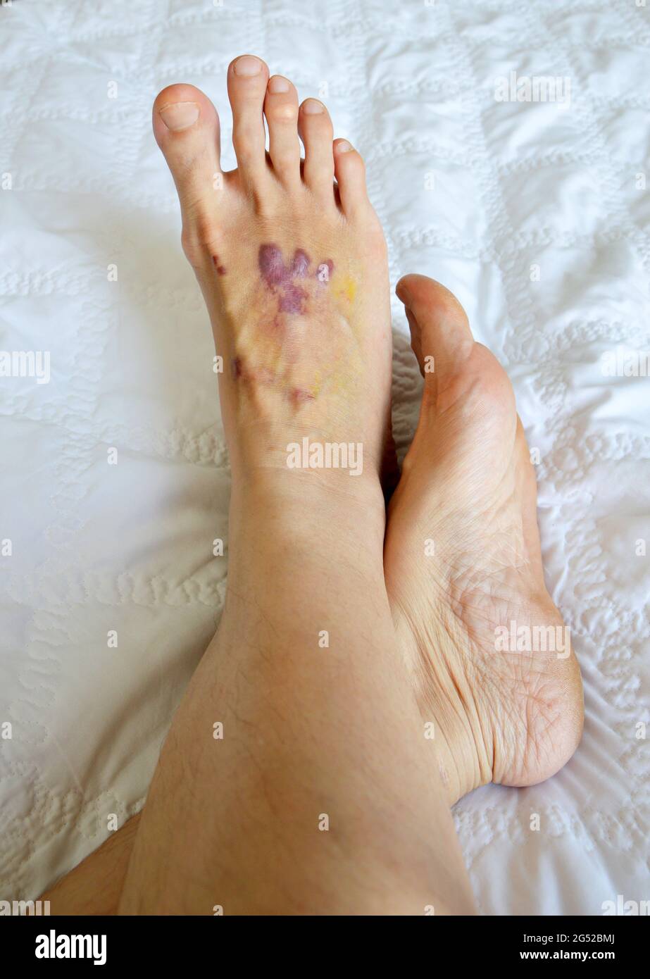 Accident scar on foot, purple skin scar, in white bed background Stock