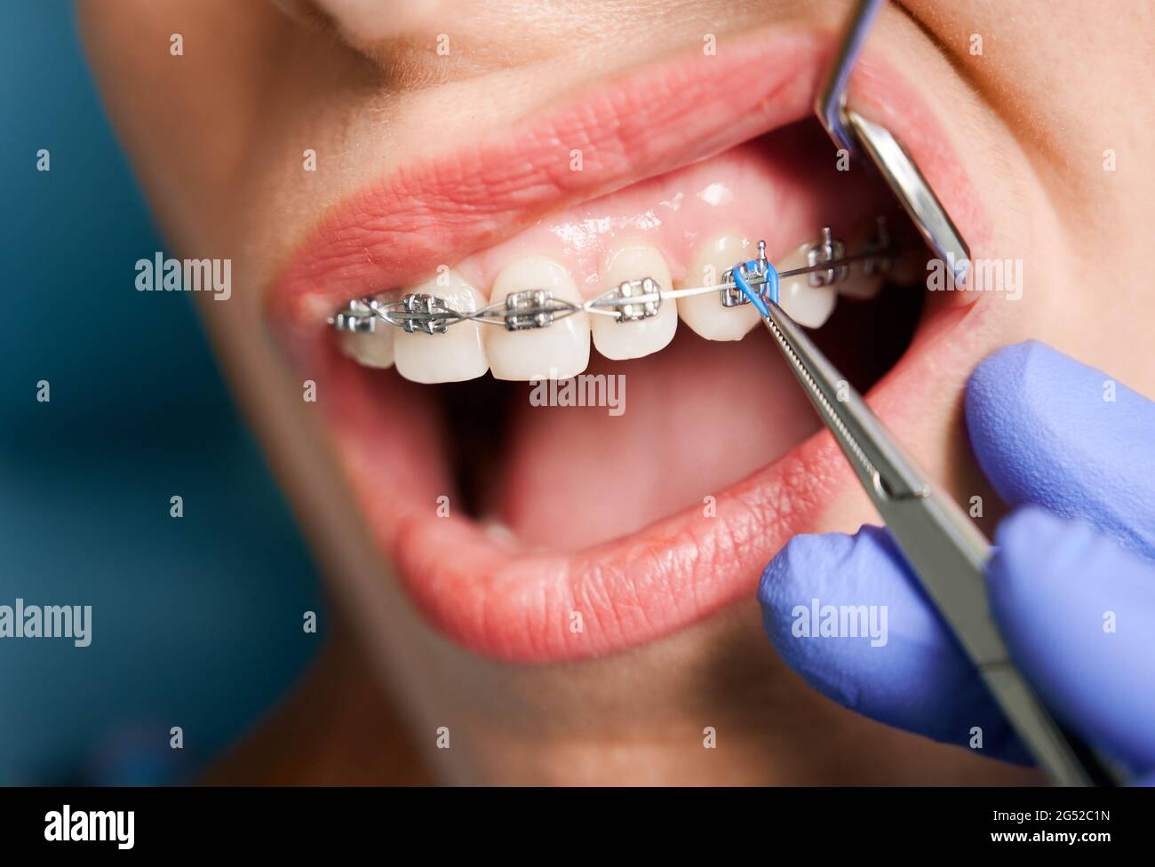 Close up of woman with brackets receiving dental braces treatment in