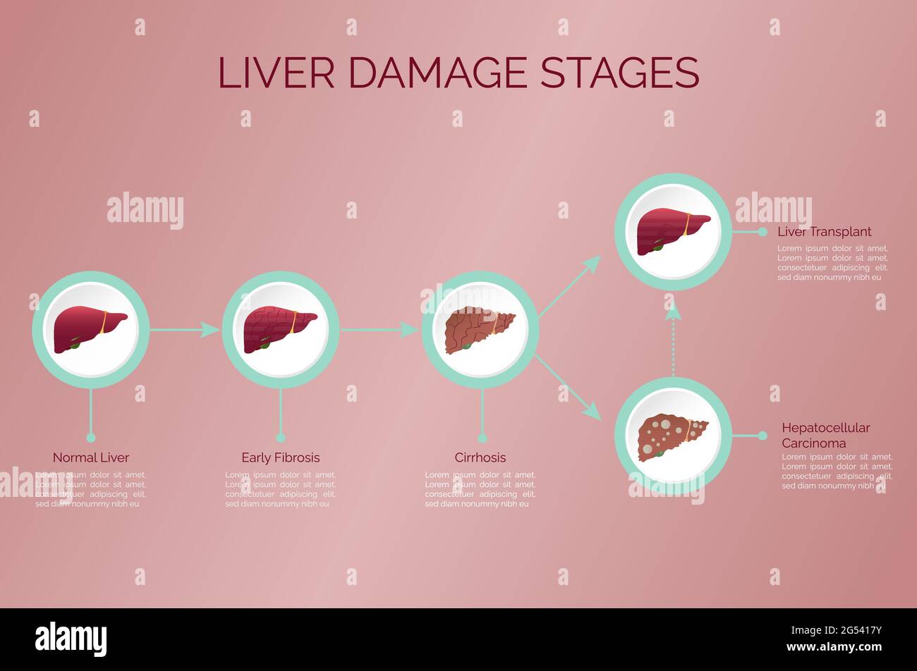 Infographic: stages of liver damage. Evolution of the liver up to transplantation. Stock Vector