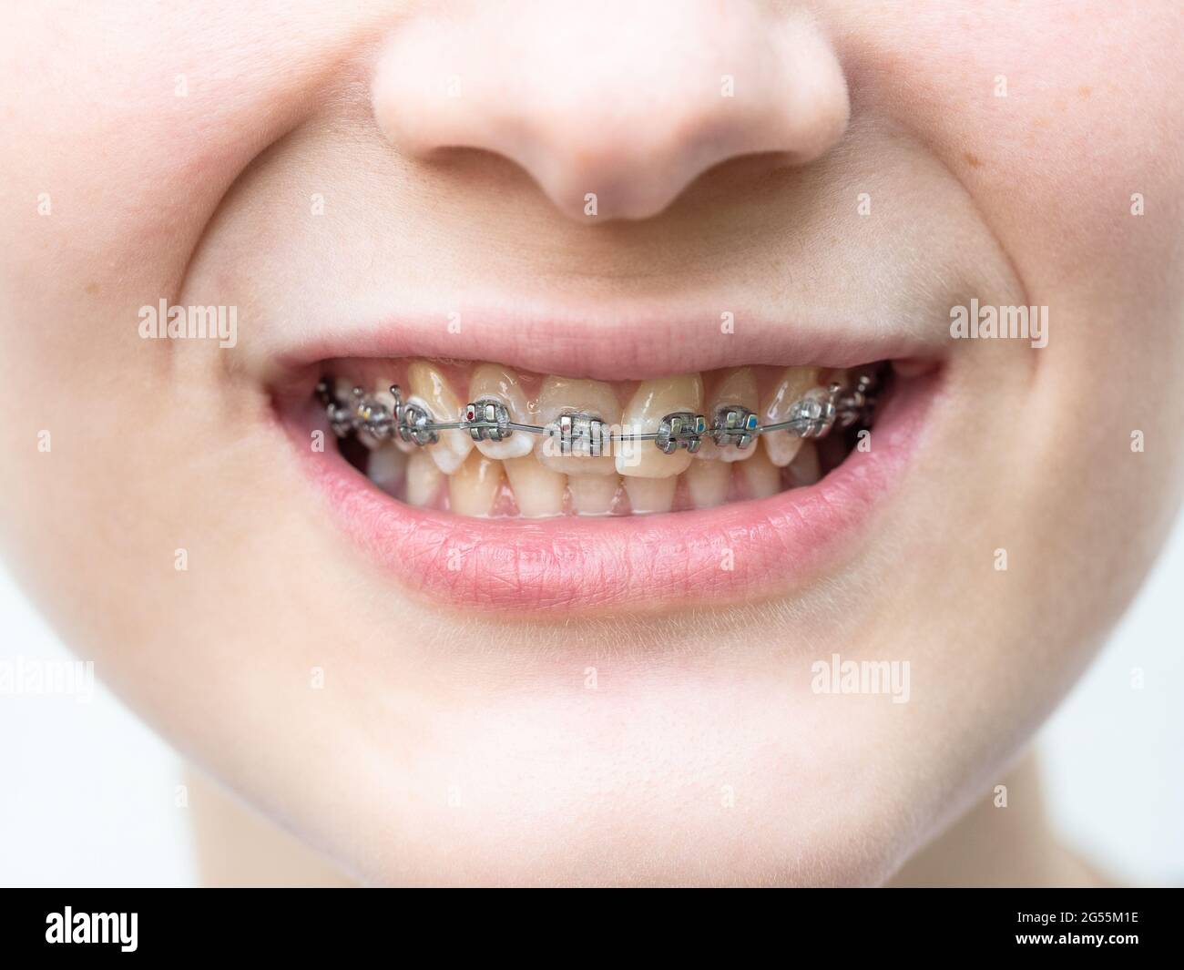 front view of orthodontic dental braces on teeth of upper jaw of girl