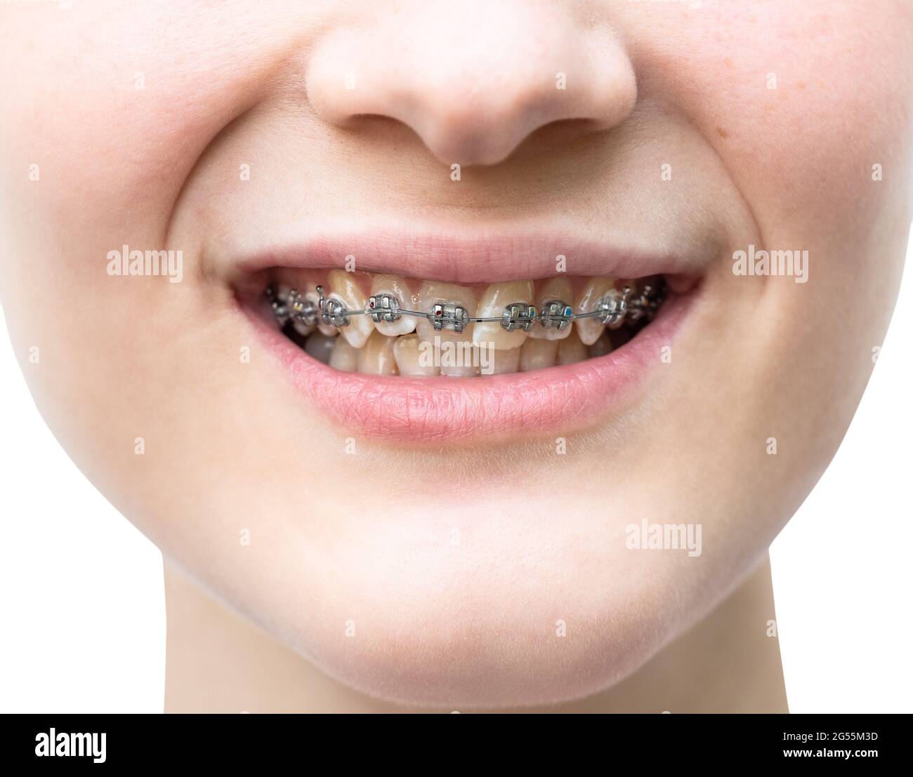 front view of metal dental braces on teeth of upper jaw of girl closeup cutout on white background Stock Photo
