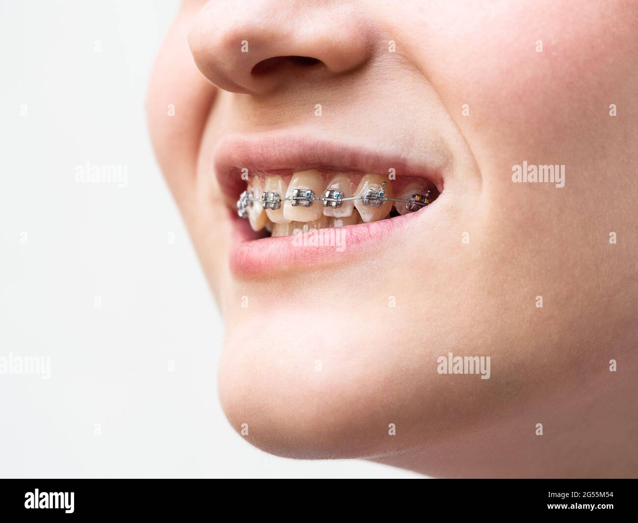 orthodontic dental braces on teeth of upper jaw of girl closeup Stock Photo
