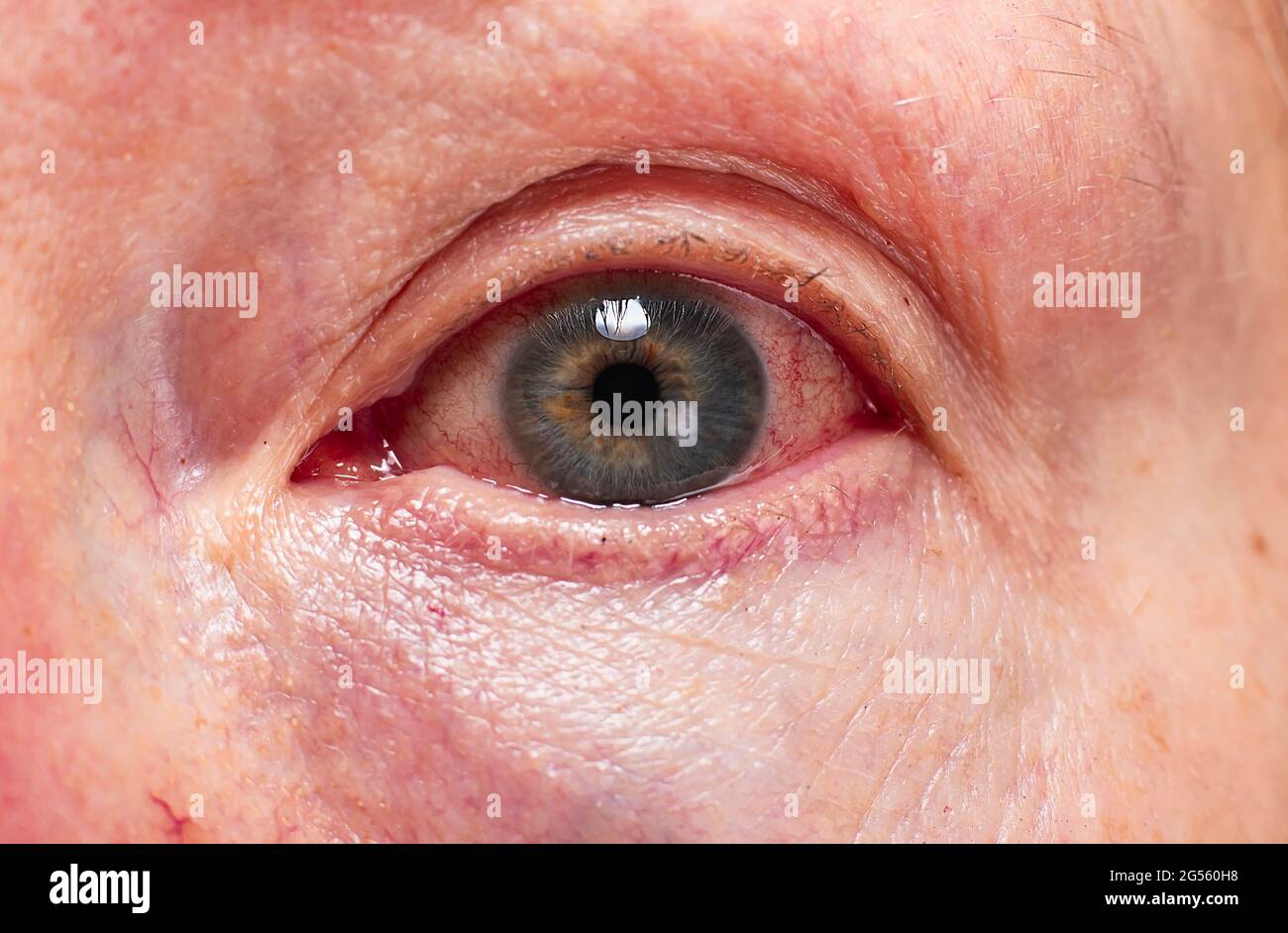 Eye hemorrhage hires stock photography and images Alamy