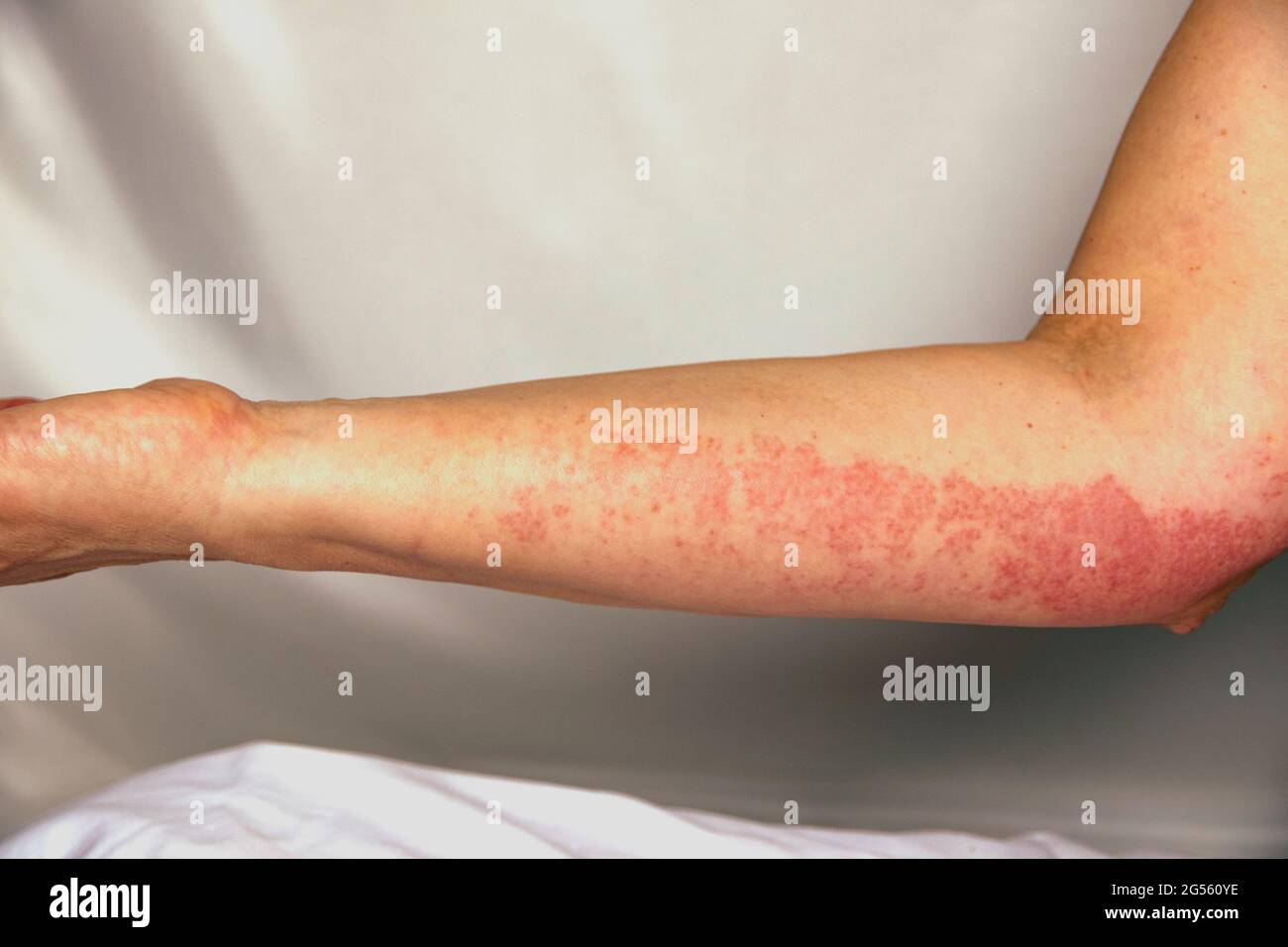 Strong allergic rashes on the arm. Impaired immunity and reaction to allergenic products