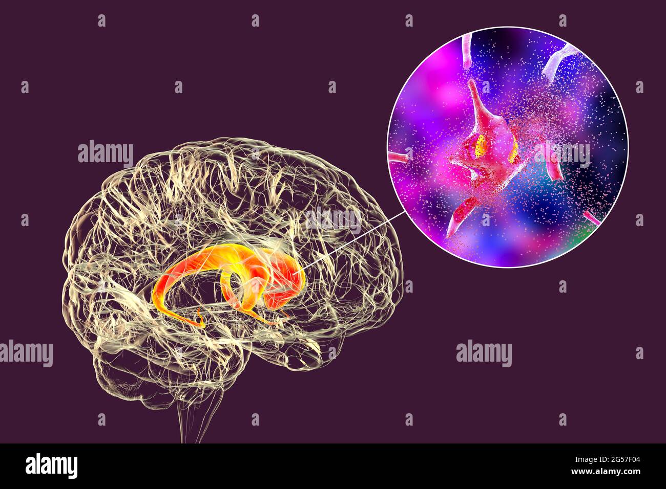 Destruction of neurons of the caudate nucleus, illustration Stock Photo