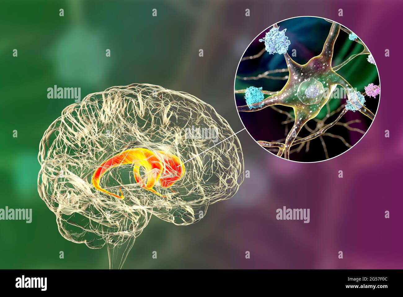 Neuronal inclusions in Huntington's disease, illustration Stock Photo