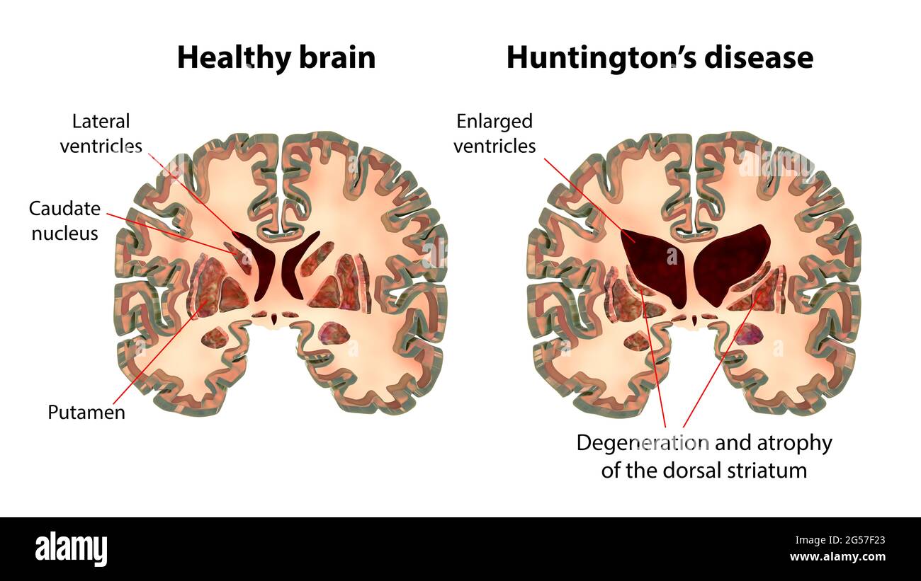 Normal brain and brain in Huntington's disease, illustration Stock Photo