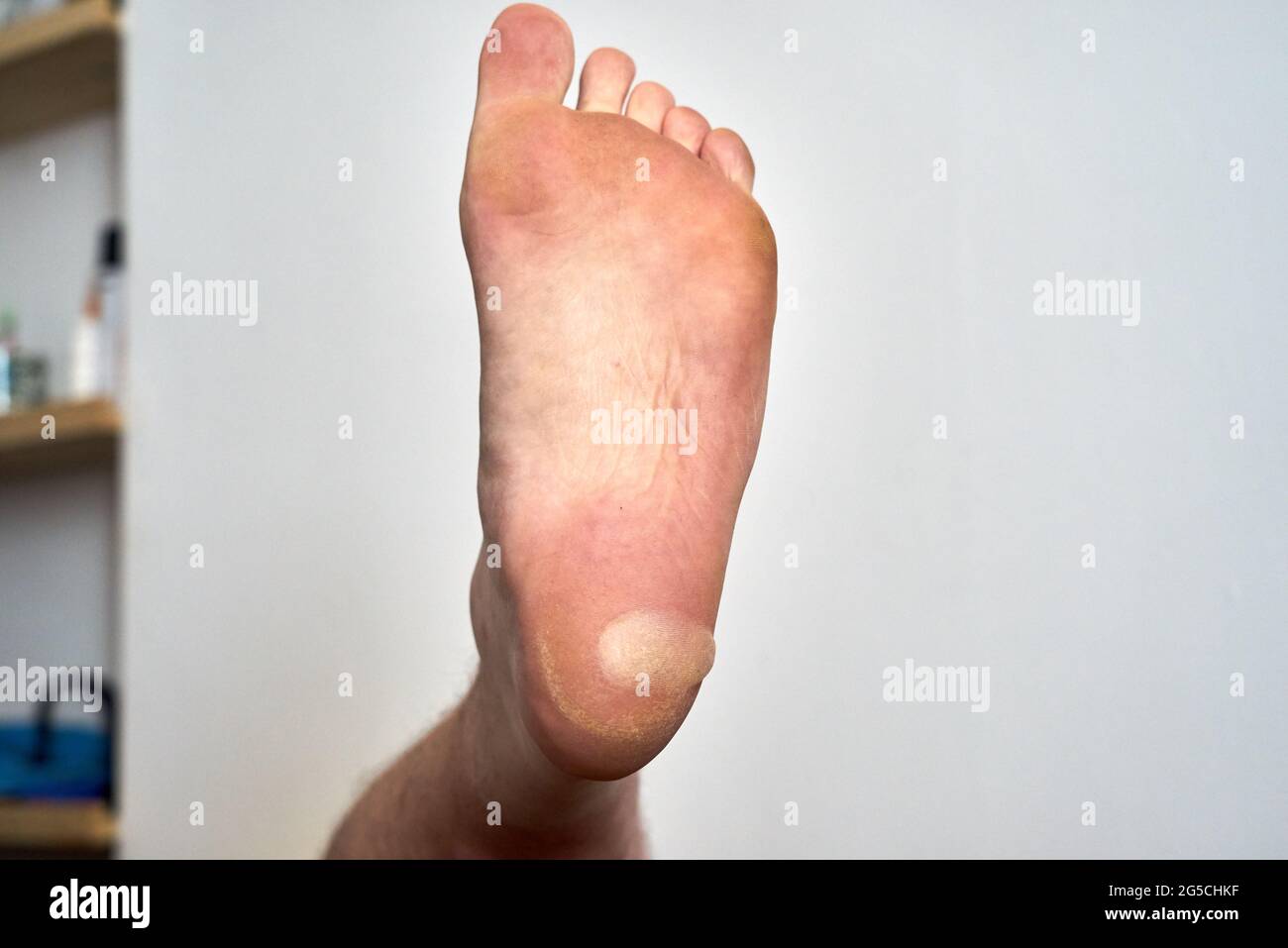 Blister foot hi res stock photography and images Alamy